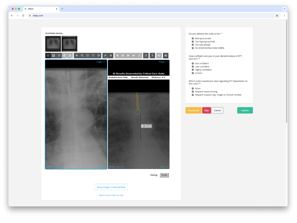 Side by side ETT CXRs one original, the other AI inferenced.
