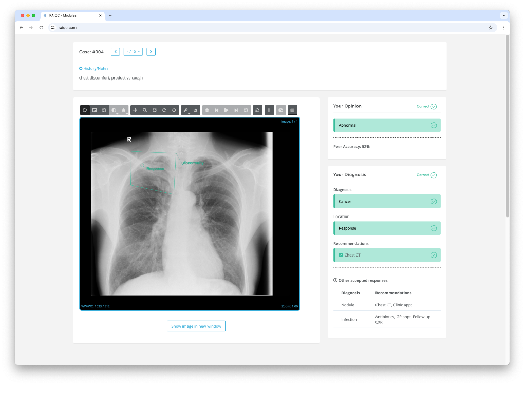 Chest X-ray with abnormality marked