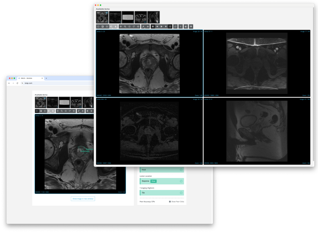 A reporting view and an image viewer displaying an Prostate MRI scan
